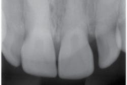 Figure 4: Upper anterior. Courtesy of Carol Perkins, RDH, BA, AS. Figure 4: Upper anterior. Courtesy of Carol Perkins, RDH, BA, AS.