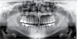 Figure 5: Panoramic x-ray. Courtesy of Carol Perkins, RDH, BA, AS Figure 5: Panoramic x-ray. Courtesy of Carol Perkins, RDH, BA, AS