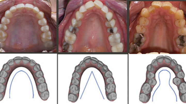 3 Hidden Benefits Of Clear Aligner Therapy Relating To Airway Health Registered Dental Hygienist Rdh Magazine