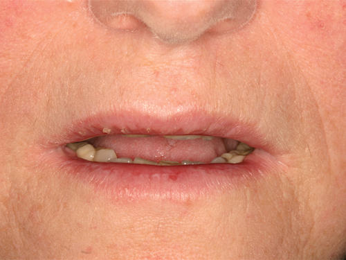 fungal infection on lips