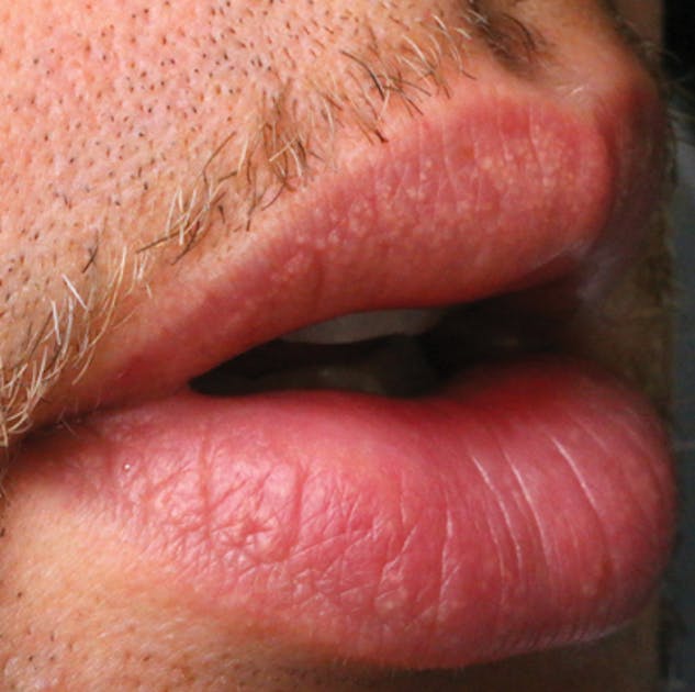 Fordyce Spots On Lips How Does It Look Causes Treatments 40 Off