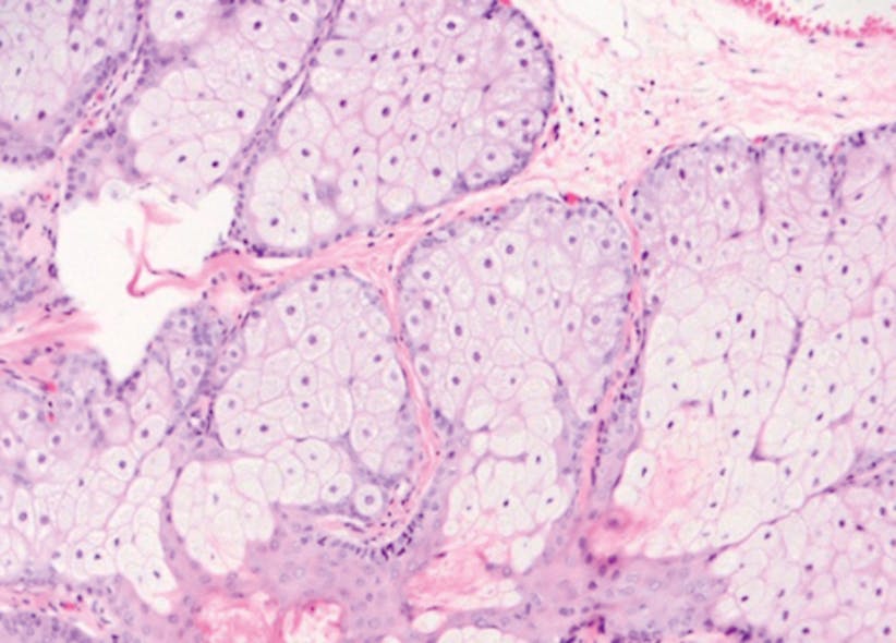 Figure 2: Fordyce granules are normal sebaceous granules composed of lobules of rounded cells with abundant clear, but coarsely granular, cytoplasm. Photo courtesy of David Klingman, DMD, diplomate of the American Board of Oral and Maxillofacial Pathology.