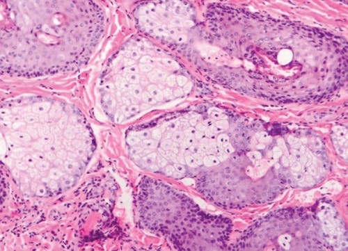 Figure 3: Fordyce granules are a variant of normal tissue anatomy, but with any tissue change, pain, exudate, ulceration, or notable enlargement may raise suspicion for an abnormality. In such cases, further evaluation may be prudent. Photo courtesy of David Klingman, DMD, diplomate of the American Board of Oral and Maxillofacial Pathology.