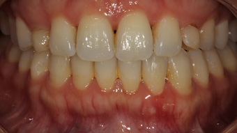 Adverse reactions to local anesthetics | Registered Dental Hygienist (RDH) Magazine Adverse reactions to local anesthetics | Registered Dental Hygienist (RDH) Magazine