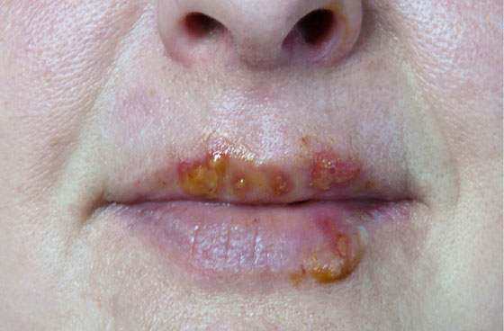 Content Dam Diq Slideshow 2014 07 Herpes Mouth
