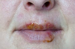 Content Dam Diq Slideshow 2014 07 Herpes Mouth Content Dam Diq Slideshow 2014 07 Herpes Mouth
