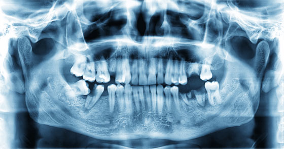 When patients refuse Xrays Registered Dental Hygienists