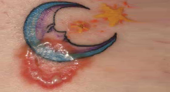 Content Dam Diq Slideshow 2014 07 Ringworm