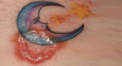 Content Dam Diq Slideshow 2014 07 Ringworm Content Dam Diq Slideshow 2014 07 Ringworm