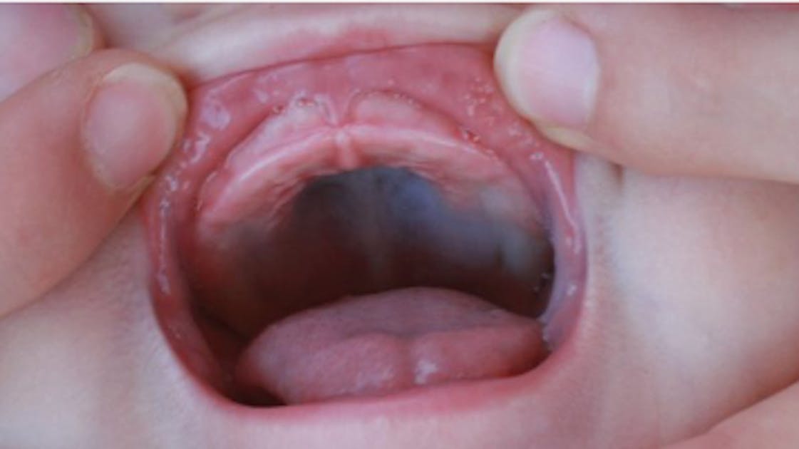 Tethered oral tissues: Signs, symptoms, and assessments