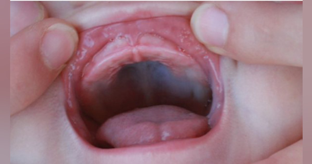 Tonsils after giving oral