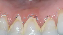 Content Dam Rdh En Articles Print Volume 37 Issue 12 Content Dam Dental Hygiene Recommendations That Can Alter Clinical Outcomes Leftcolumn Article Thumbnailimage File