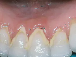 Content Dam Rdh En Articles Print Volume 37 Issue 12 Content Dam Dental Hygiene Recommendations That Can Alter Clinical Outcomes Leftcolumn Article Thumbnailimage File Content Dam Rdh En Articles Print Volume 37 Issue 12 Content Dam Dental Hygiene Recommendations That Can Alter Clinical Outcomes Leftcolumn Article Thumbnailimage File