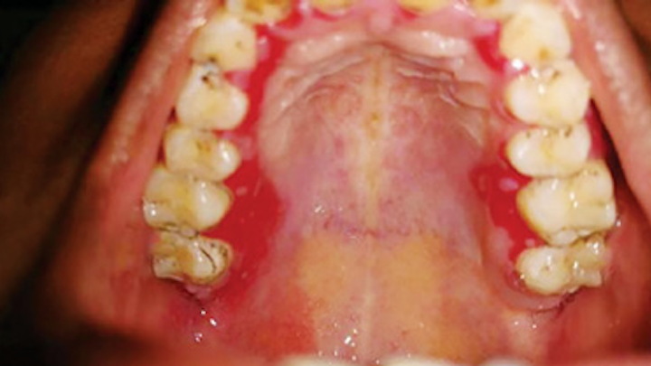 Content Dam Rdh En Articles Print Volume 38 Issue 1 Content Dam Vision Loss From Mmp Leftcolumn Article Thumbnailimage File