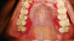 Content Dam Rdh En Articles Print Volume 38 Issue 1 Content Dam Vision Loss From Mmp Leftcolumn Article Thumbnailimage File