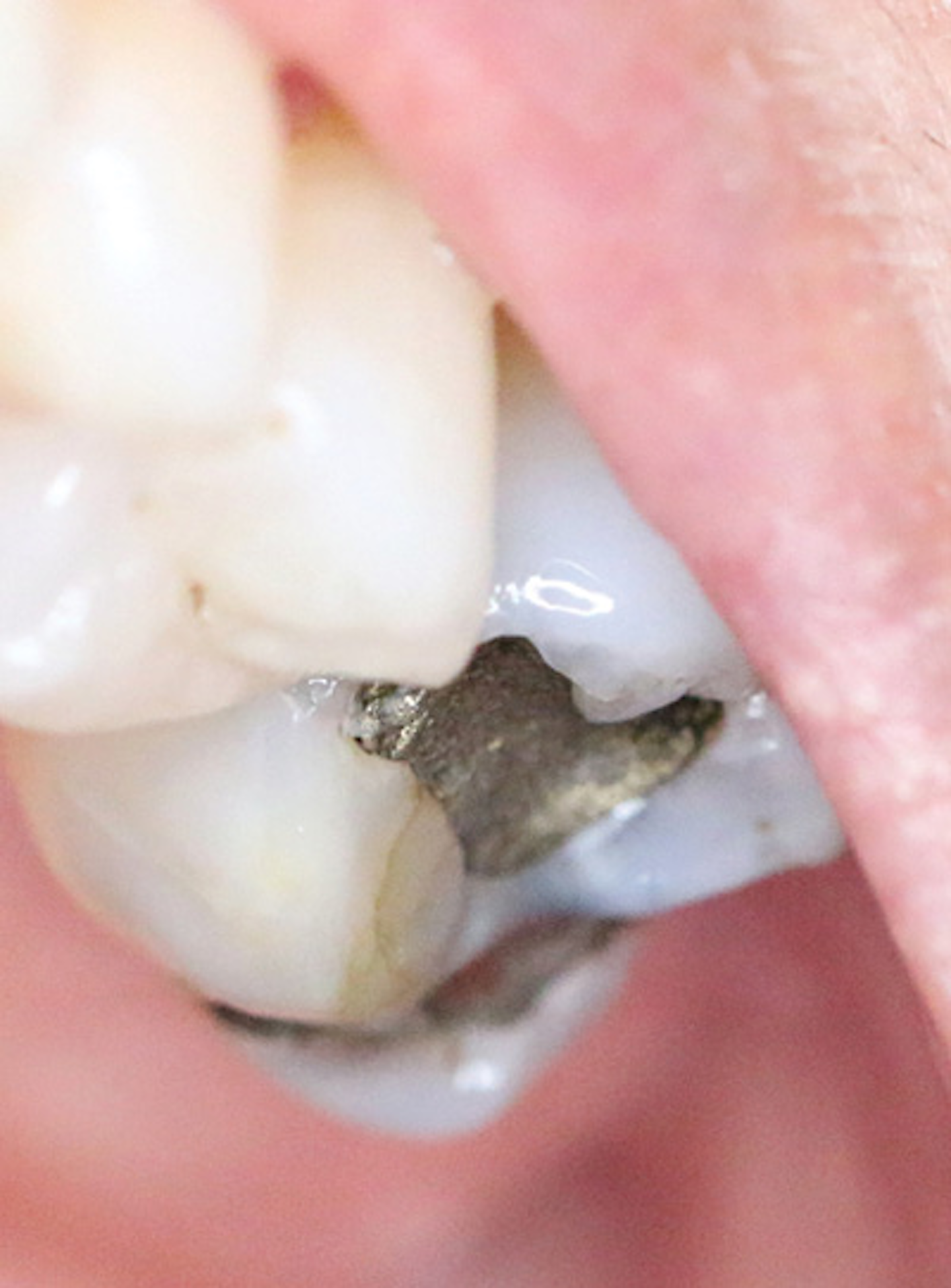 Lichen planus Registered Dental Hygienist (RDH) Magazine