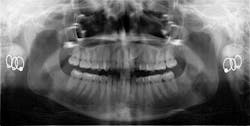 Content Dam Rdh En Articles Slideshows 2014 08 Dental Photo Of The Day 23 Leftcolumn Article Thumbnailimage File Content Dam Rdh En Articles Slideshows 2014 08 Dental Photo Of The Day 23 Leftcolumn Article Thumbnailimage File