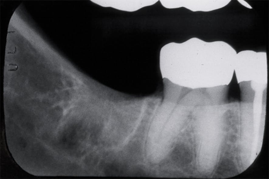 What are the implications of residual root sockets? | Registered Dental ...