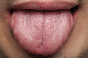 Toothpaste ingredients can lead to lesions | Registered Dental Hygienist  (RDH) Magazine