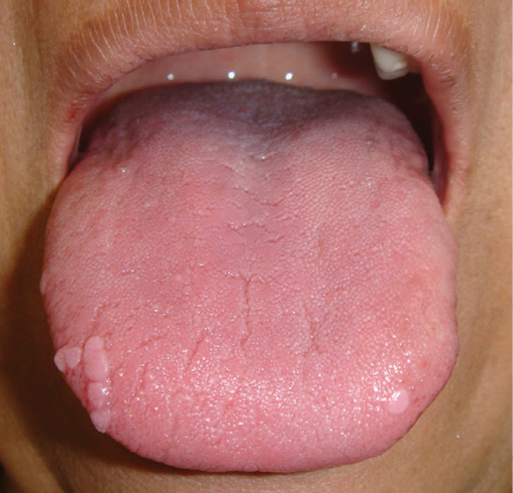 hpv on tongue)