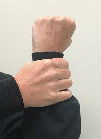 Figure 5: Using the dominant hand, grip the nondominant hand&rsquo;s wrist to show the patient how a healthy bone height gives the tooth stability.