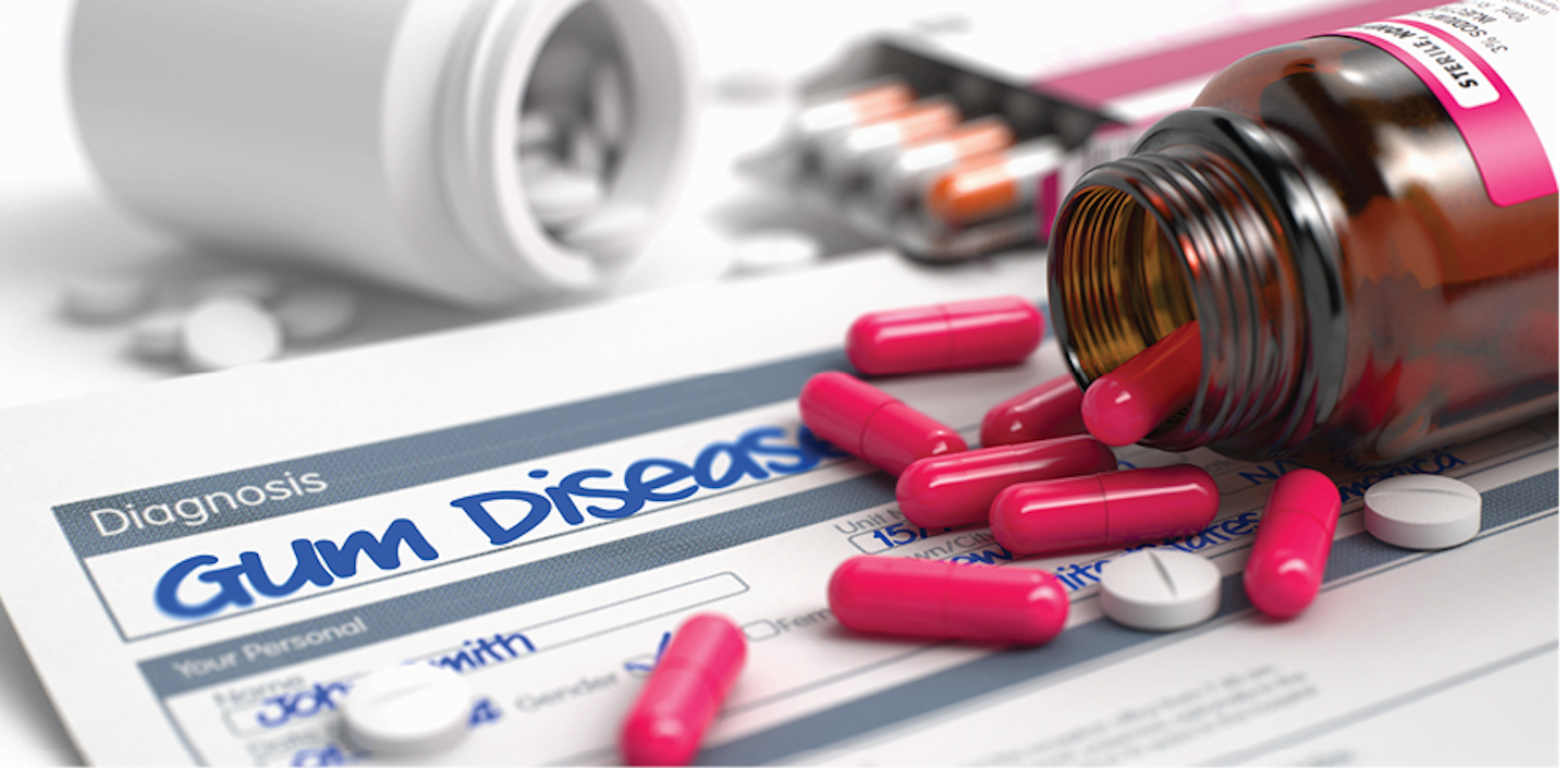 Systemic antibiotics to treat periodontal disease Are we causing more