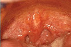 Figure 1: This image shows lymphoid hyperplasia in the soft palate, uvula, and posterior pharynx.