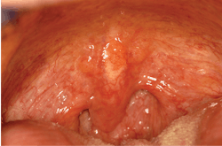 Figure 1: This image shows lymphoid hyperplasia in the soft palate, uvula, and posterior pharynx. Figure 1: This image shows lymphoid hyperplasia in the soft palate, uvula, and posterior pharynx.