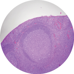 Figure 2: This image shows a lymphoid follicle under microscope. Note the “polarized” mantle zone beneath a somewhat attenuated epithelium. Within the germinal center are more pale-staining cells that are tingible body macrophages. Figure 2: This image shows a lymphoid follicle under microscope. Note the “polarized” mantle zone beneath a somewhat attenuated epithelium. Within the germinal center are more pale-staining cells that are tingible body macrophages.
