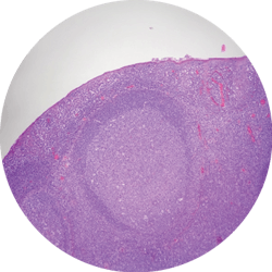 Figure 2: This image shows a lymphoid follicle under microscope. Note the “polarized” mantle zone beneath a somewhat attenuated epithelium. Within the germinal center are more pale-staining cells that are tingible body macrophages. Figure 2: This image shows a lymphoid follicle under microscope. Note the “polarized” mantle zone beneath a somewhat attenuated epithelium. Within the germinal center are more pale-staining cells that are tingible body macrophages.