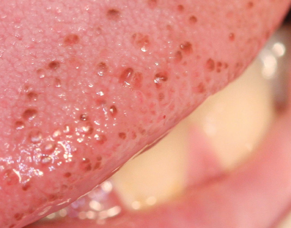 Tongue papillae pain