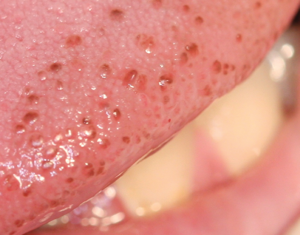diagnosi del papilloma virus nell uomo