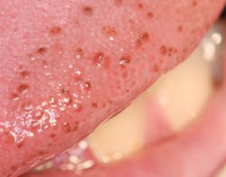 Figure 2: Pigmented fungiform papillae. Photo courtesy of Jerry E. Bouquot, DDS, MSD. Figure 2: Pigmented fungiform papillae. Photo courtesy of Jerry E. Bouquot, DDS, MSD.