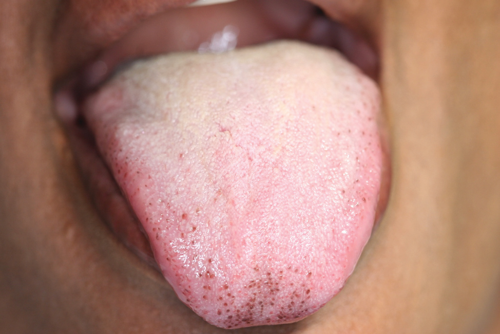 vallate papillae tongue treatment