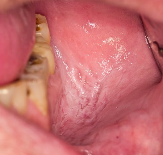 Figure 1: Placement of aspirin next to the tooth to relieve pain