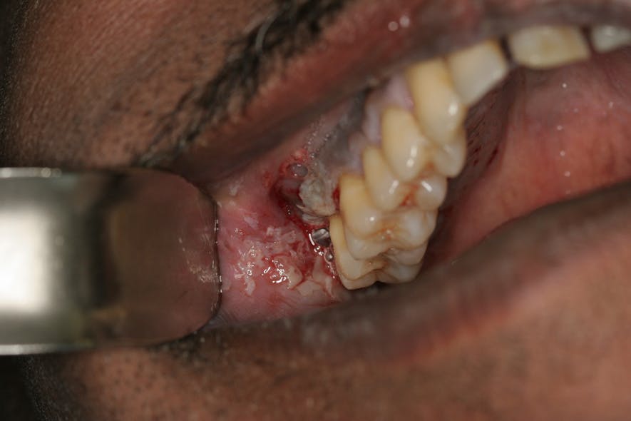 Figure 2: Placement of garlic on a tooth to relieve pain