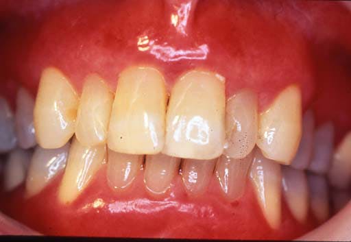 Figure 3: Cinnamon and toothpaste reactions: contact allergy causing gingival redness