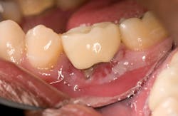 Figure 4: Smokeless tobacco placed in first and second molar region, resulting in smokeless tobacco keratosis(1,3) Figure 4: Smokeless tobacco placed in first and second molar region, resulting in smokeless tobacco keratosis(1,3)