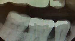 FIGURE 1: Patient x-ray from 2019, showing an accretion that does not look like typical calculus and a large space under the deposit. FIGURE 1: Patient x-ray from 2019, showing an accretion that does not look like typical calculus and a large space under the deposit.