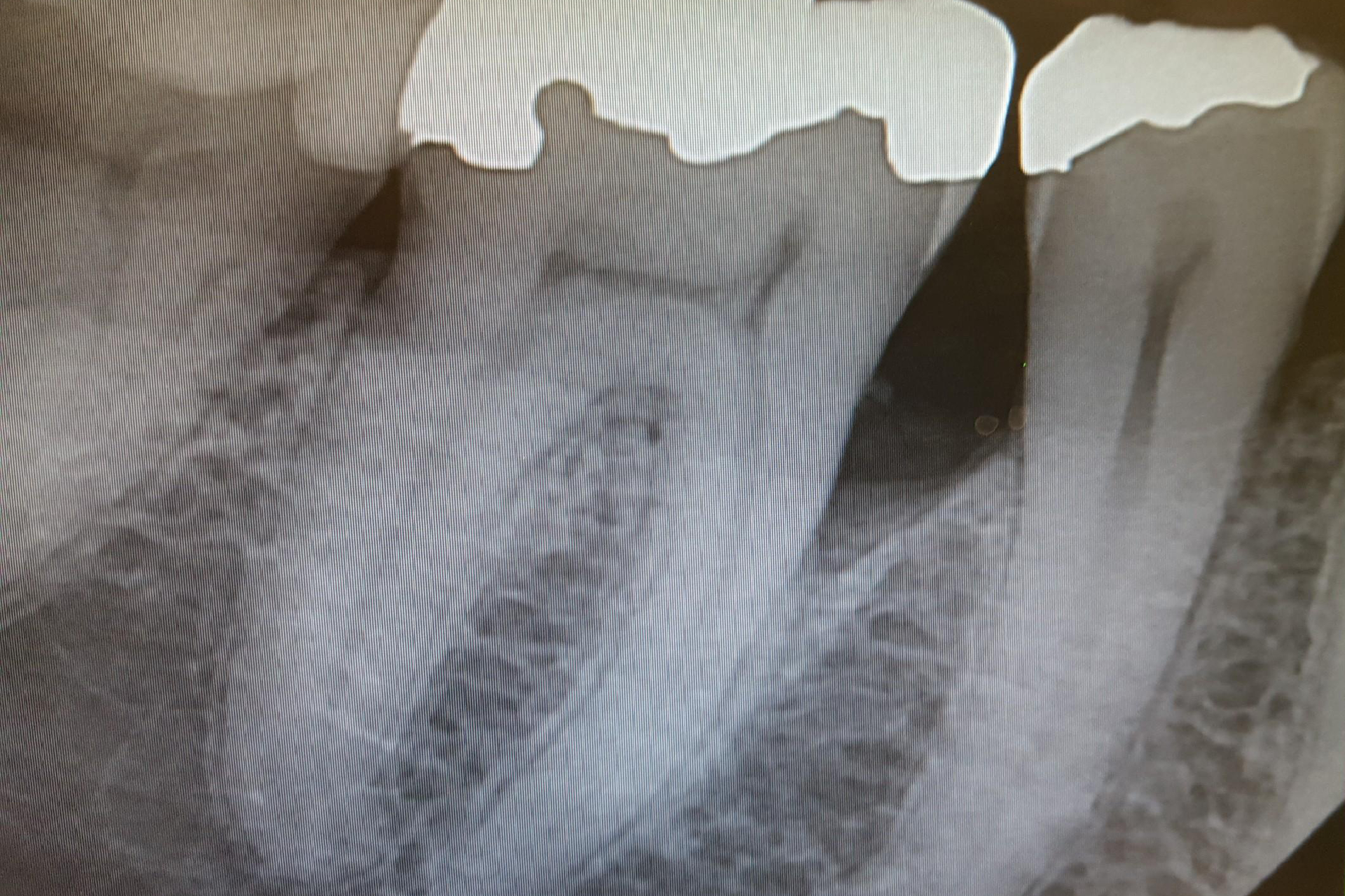 dental calculus x ray