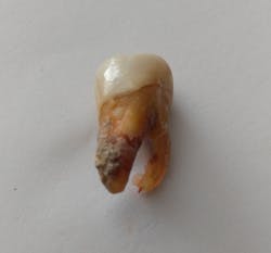 FGURE 3: Tooth No. 3 lost due to periodontal infection and deep calculus.
