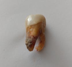 FGURE 3: Tooth No. 3 lost due to periodontal infection and deep calculus. FGURE 3: Tooth No. 3 lost due to periodontal infection and deep calculus.