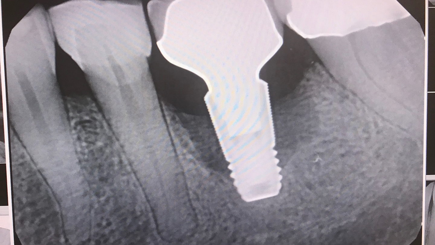 How to identify a failing implant A dental hygienist’s perspective