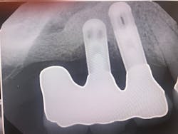 Figure 2: Radiograph of failed implant Figure 2: Radiograph of failed implant