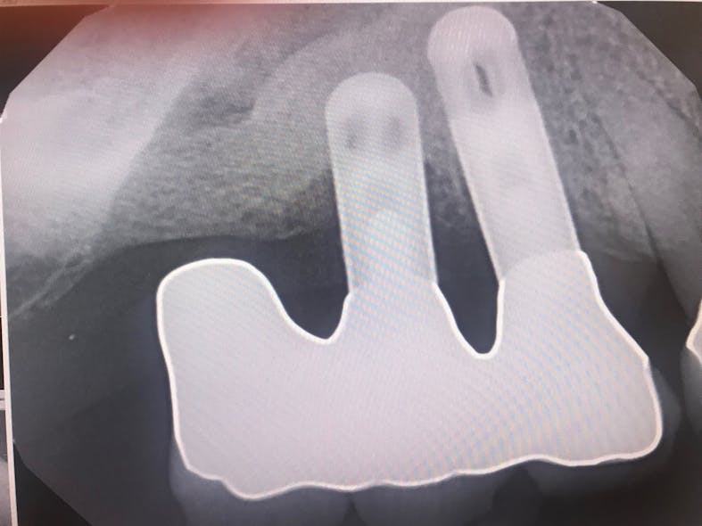 Figure 2: Radiograph of failed implant