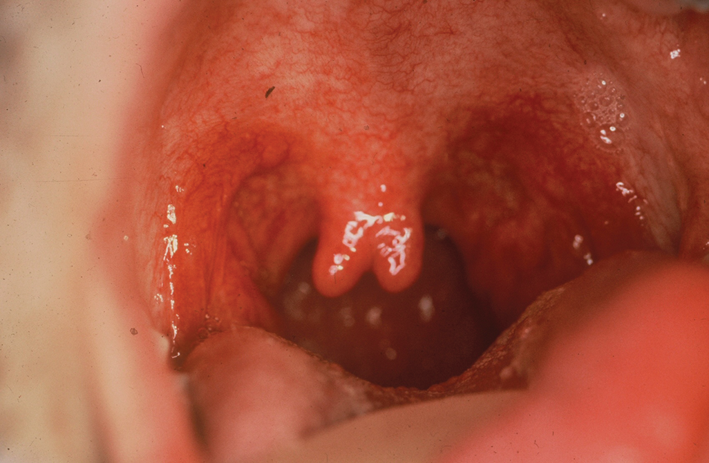 Figura 1: uvula Bifid. Foto cortesia do Dr. Carolyn Bentley.Figura 1: uvula Bifid. Foto cortesia do Dr. Carolyn Bentley.