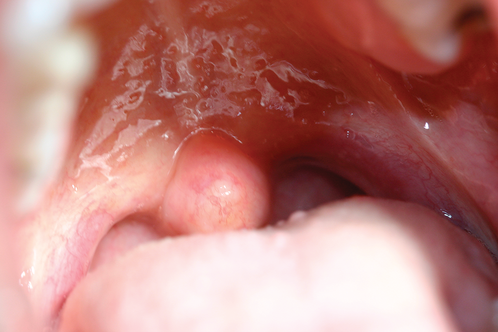 2. ábra: lekerekített uvula