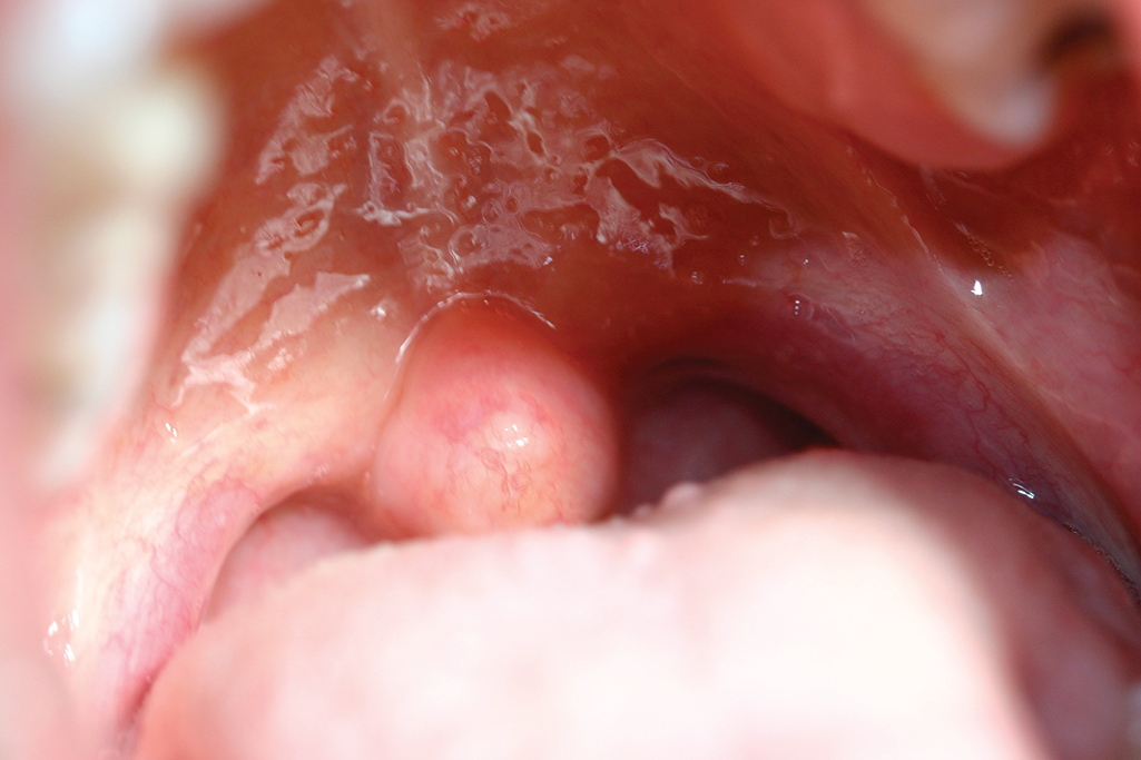 Figur 2: rundad uvula