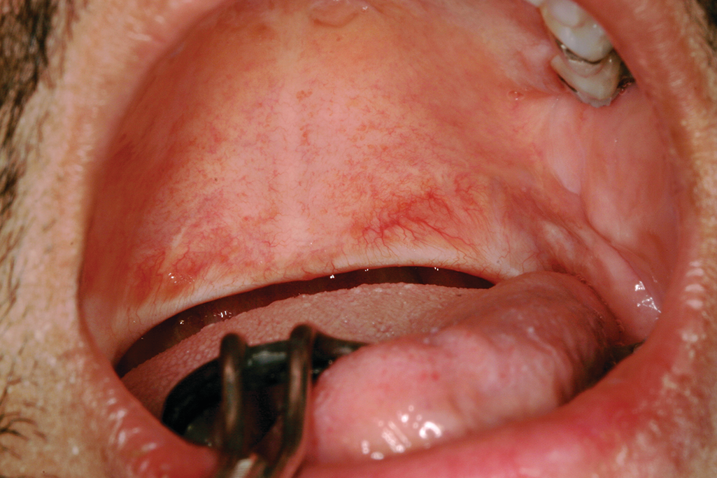 obrázek 3: předchozí uvulektomie