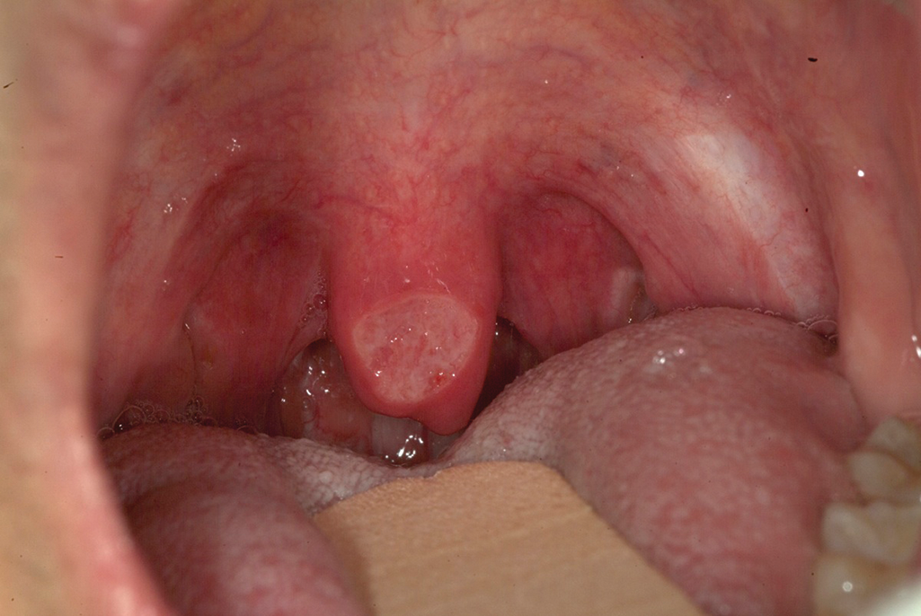 Figura 4: úvula com uma úlcera. Foto cortesia do Dr. A. Ross Kerr.Figura 4: úvula com úlcera. Foto cortesia do Dr. A. Ross Kerr.